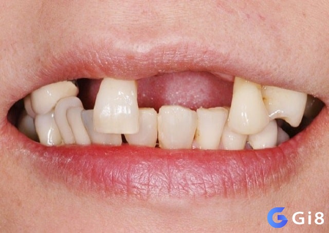 Giấc mơ thấy rụng răng hàm trên là điềm báo về nỗi lo lắng cho sức khỏe của người thân